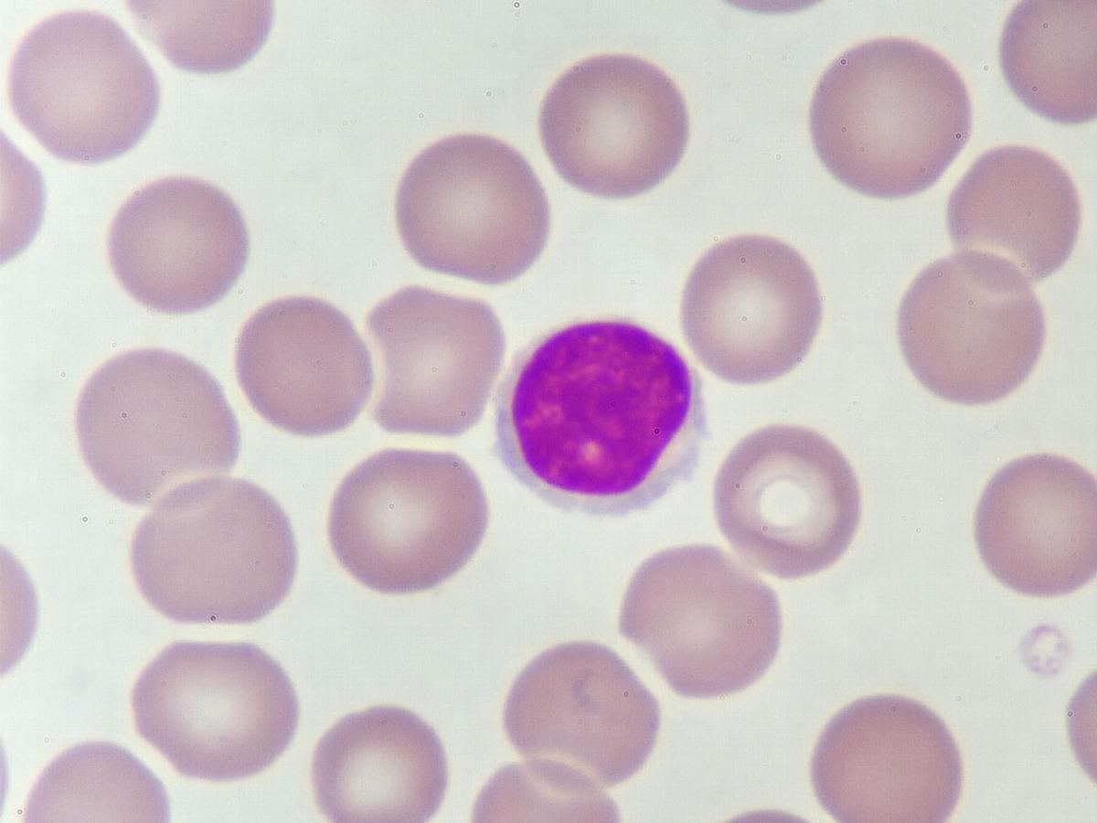 משטח דם של לוקמיה לימפוציטית כרונית (CLL), אנליזה במיקרוסקופ (תמונה: Shutterstock)